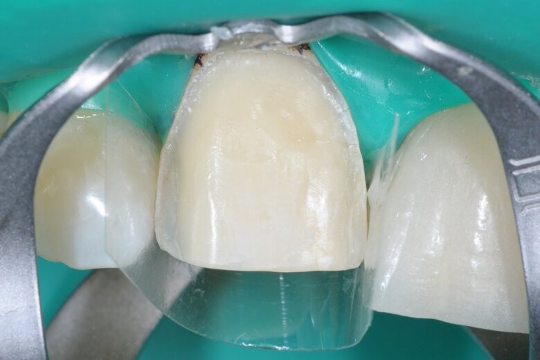 Fig. 13 Rubber dam fitted to enable controlled adhesive cementation.