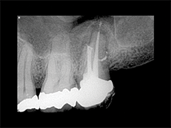 Slika 5:Prikazuje slučaj pogodan za reviziju punjenja s obzirom na loš rezulatat prethodne terapije kanala korena. Uz odgovarajuću obradu i irigaciju(Sleimanova faza) i zahvaljujući teškoj ali uspešnoj potrazi za distalnim kanalom, izvršena je 3-D opturacija kanala koja pokazuje suženje između mezijalnog i distalnog kanala kao i veoma visoko postavljene lateralne kanaliće u palatinalnom kanalu.