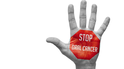 Statt Chemotherapie: Medikament zur Therapie von Mundkrebs