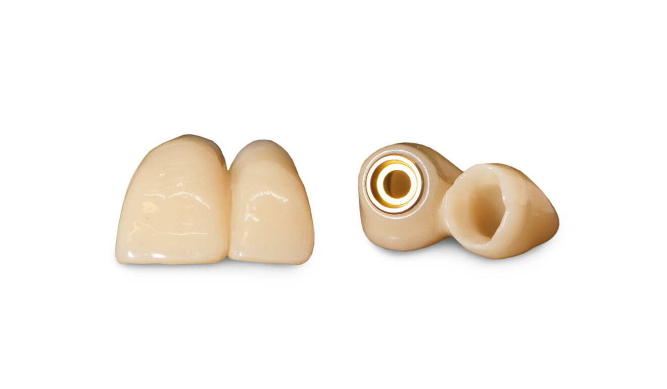 Fig. 7: Laboratory-made temporary restorations.