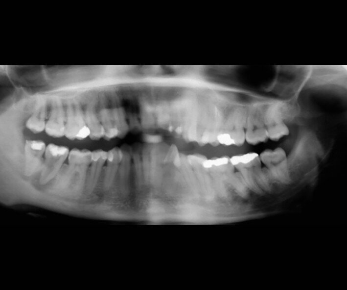 Fig. 18a: Radiographs: Pre-op panoramic.