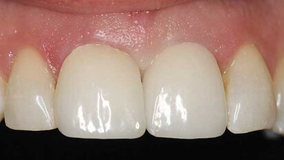 Controlling tissue contours with a prosthetically driven approach to implant dentistry Controlling tissue contours with a prosthetically driven approach to implant dentistry