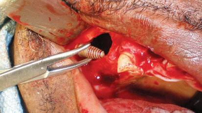 Implants displaced into the maxillary sinus