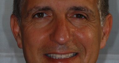 Impianti Direct Laser Metal Forming (DLMF): dalla ricerca alle applicazioni cliniche