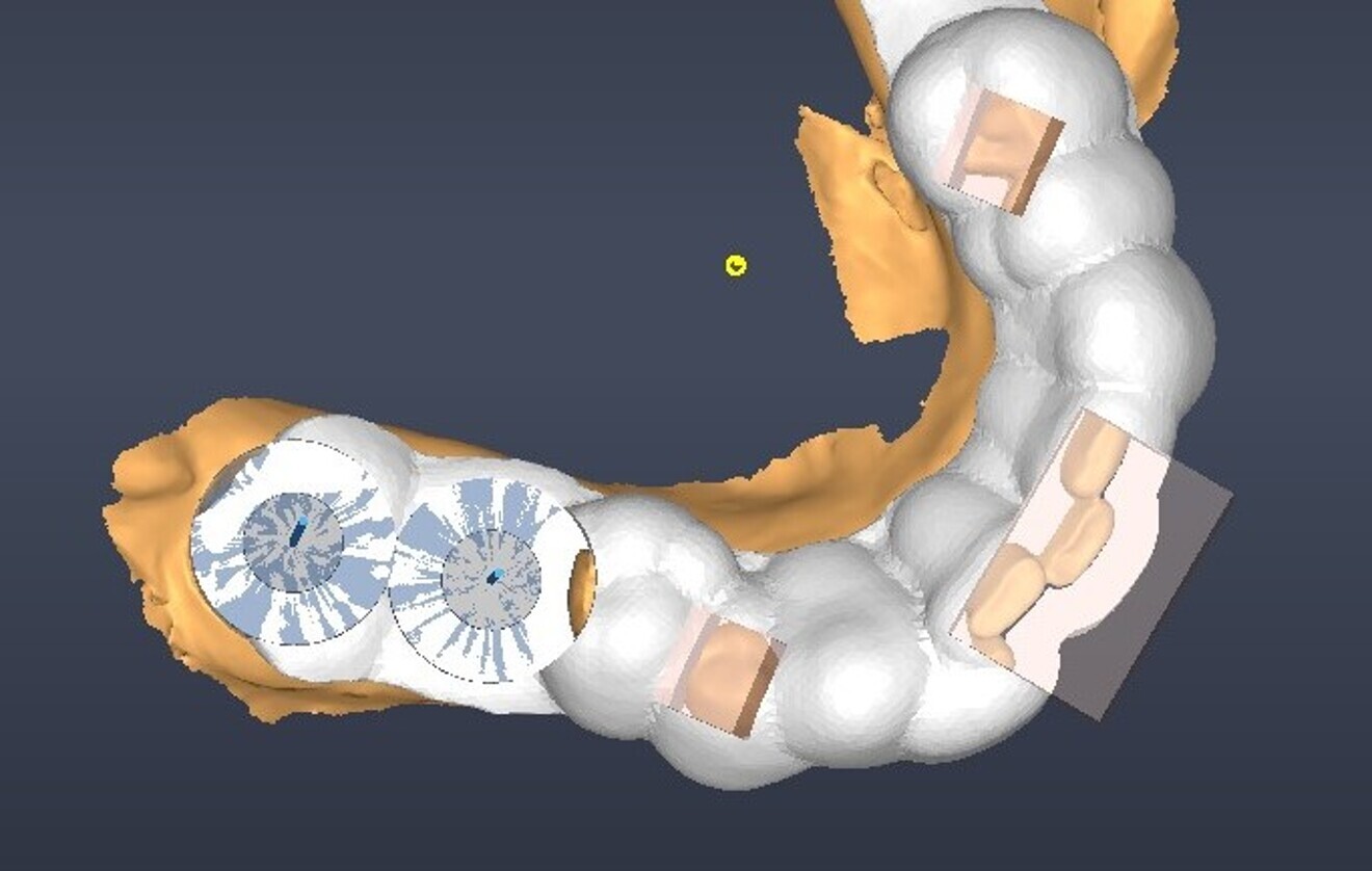 Fig. 6: Surgical guide design.