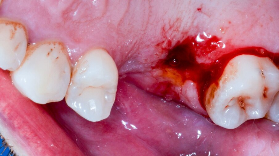 Fig. 16 – L’impianto subito dopo il suo posizionamento in chirurgia flapless; approccio preferito in questo caso per l’imprevedibilità della guarigione come già espresso nel testo.