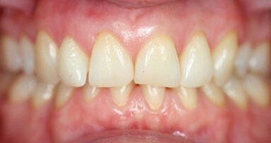 Kosmetische Zahnregulierung