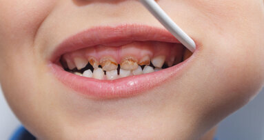 School dental programme prevents 80% of cavities with one-time, non-invasive treatment