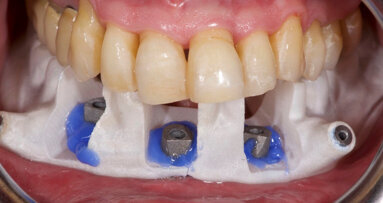 Extraoral digitalization: A digital protocol for surgical treatment of edentulous patients
