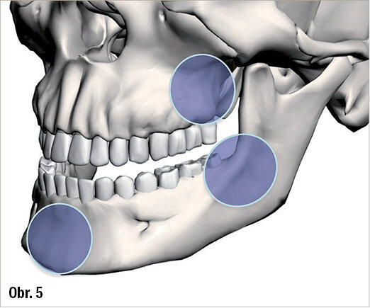 Místa odběru kosti na čelistech: crista zygomaticoalveolaris a tuber maxillae, brada, linea obliqua a úhel mandibuly