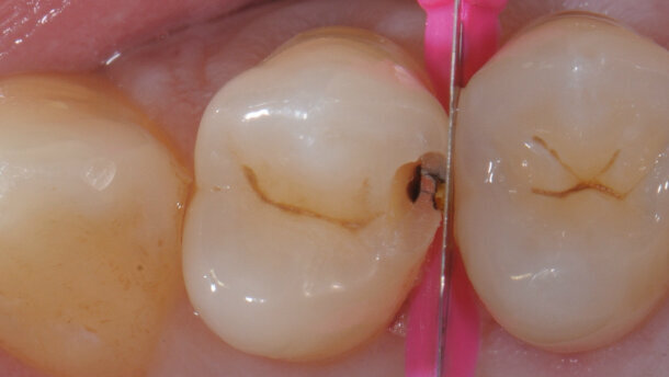 Restauri diretti in composito con le nuove matrici V4-Ring Micerium