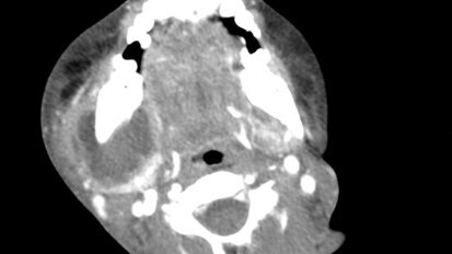 Linfoadenopatia ascessualizzata di origine odontogena: case report