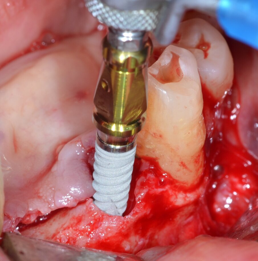 Fig. 6 - La macrogeometria dell’impianto (Resista IA3413) permette la stabilizzazione dell’impianto anche in creste ossee fortemente atrofiche.