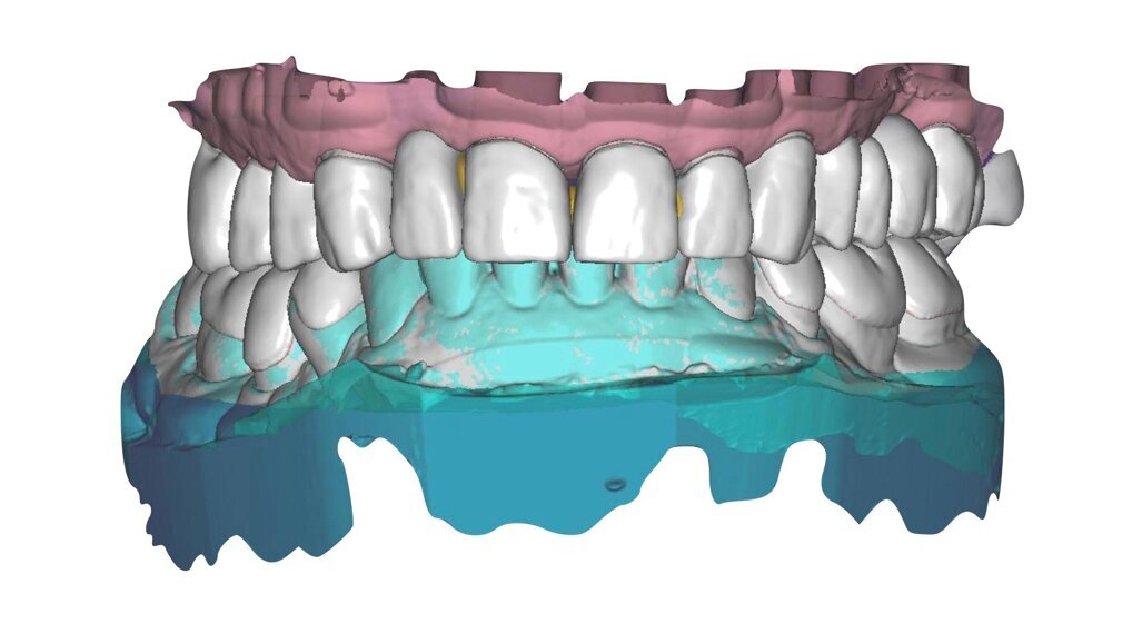 Procedure digitali per il design di una occlusione sequenziale in un caso clinico complesso