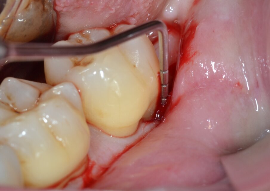Fig. 1 - Sondaggio parodontale elemento 3.7 (aspetto buccale).