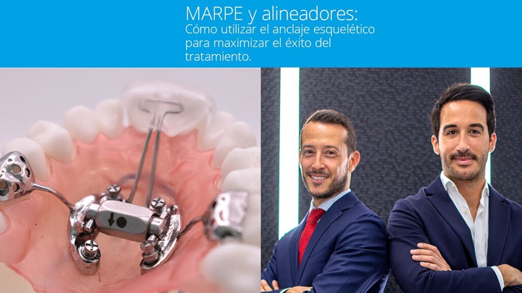 Curso MARPE y alineadores: cómo utilizar el anclaje esquelético