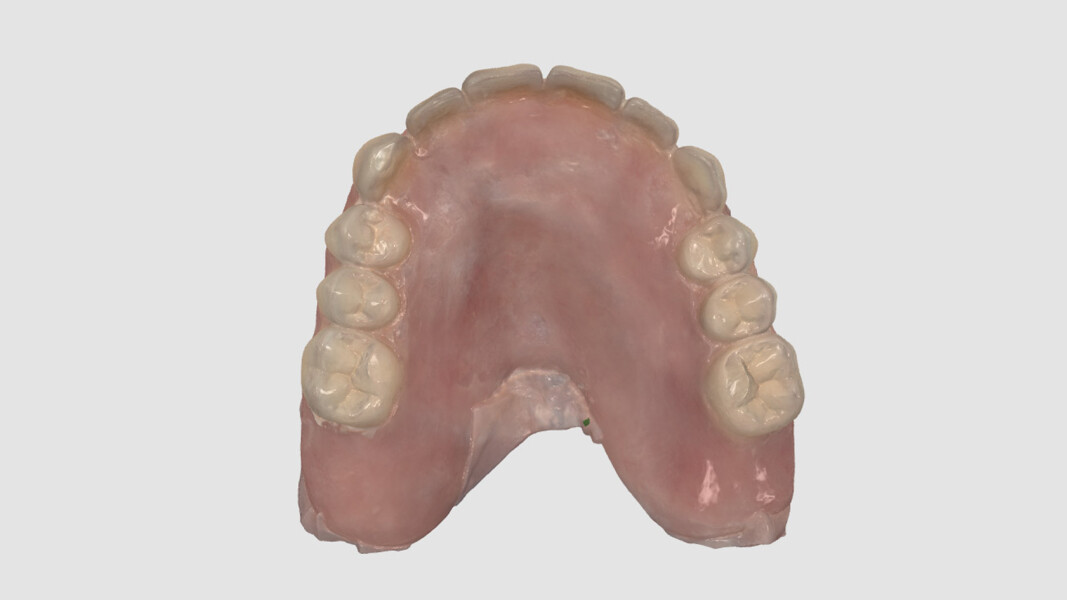 Fig. 5_Rilevamento digitale della protesi provvisoria funzionalizzata, comprensivo delle flange e dei volumi coronali.