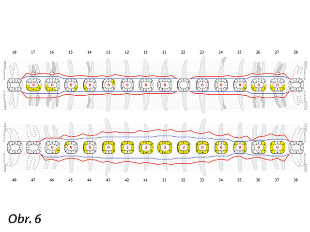 Obr. 6: Hloubka parodontálních kapes u pacientky při vstupním vyšetření