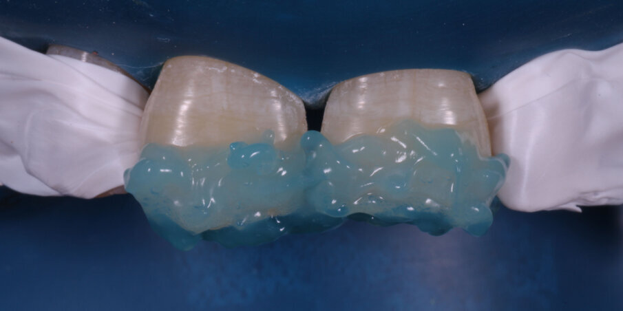 Fig 8. Etching with 37% Phosphoric Acid 