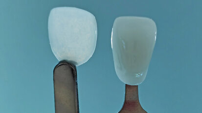 Launch of UltraThineer, world’s thinnest cosmetic dental veneer