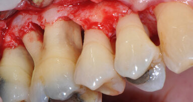 Full Mouth Instrumentation: l’efficacia in terapia antibiotica