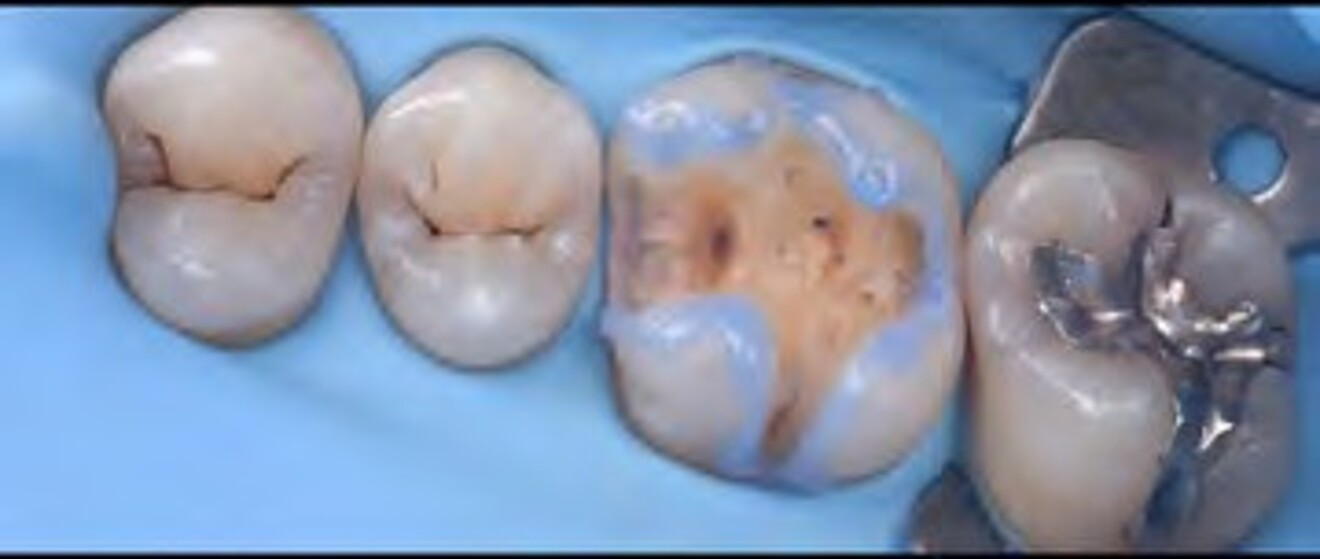  Fig. 2d: Initial finishing of the composite restoration to establish the primary occlusal anatomy