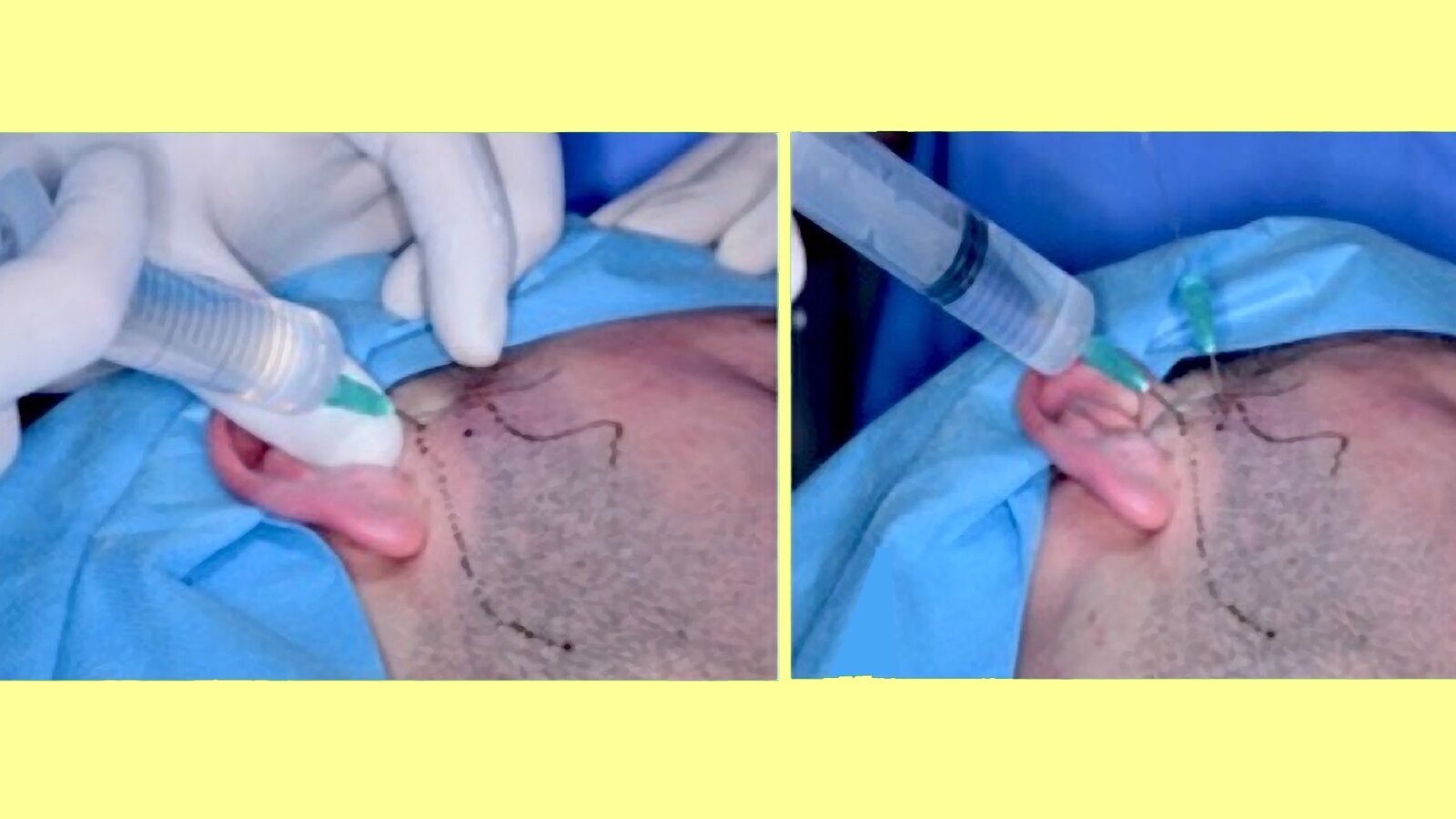 Tratamiento quirúrgico mínimamente invasivo de la ATM (3)