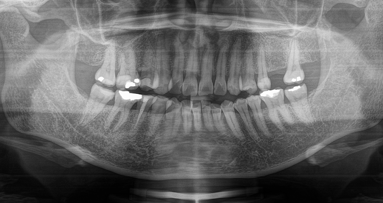 Utilising R-SWEEPS laser-assisted irrigation for the treatment of chronic periapical periodontitis