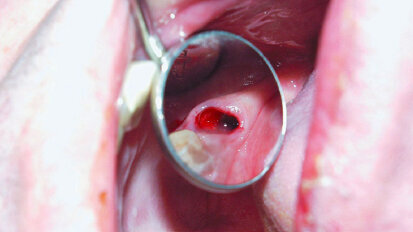 Atraumatické extrakce s Luxator Periotome