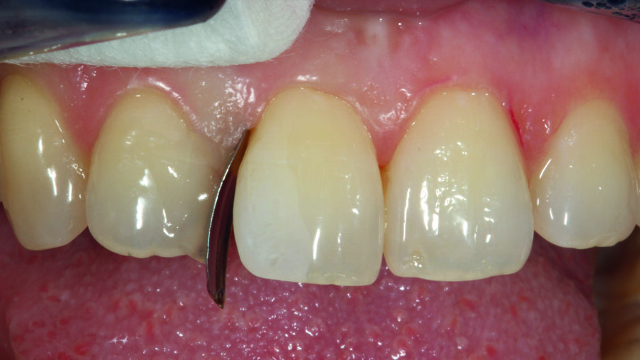 Afbeelding 3. Bekleding met behulp van een verticaal ingevoegde deelmatrix, bevestigd aan de tand. Het krijtachtige etspatroon op element 11 toont de situatie na het conditioneren met fosforzuur.