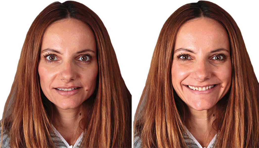 Fig. 2b: Fotografías extraorales después del tratamiento de ortodoncia.