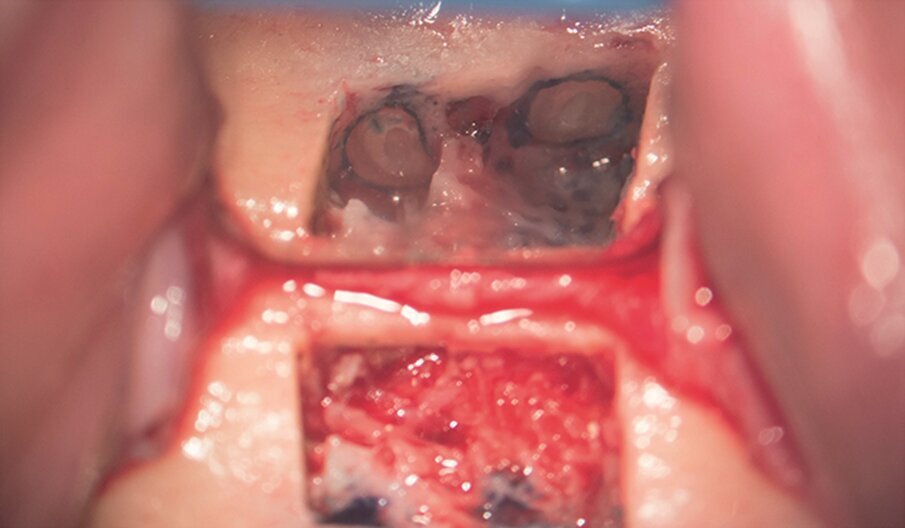 … to access the apical area and perform the apicectomy, apical cavity preparation and retro-filling of the mesial and distal roots (i).