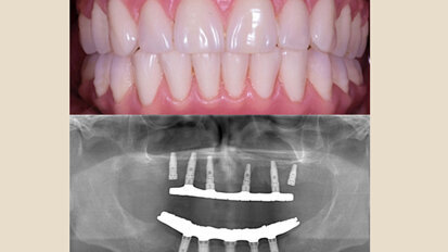Prótesis Híbrida Inmediata en pacientes edéntulos mandibulares Prótesis Híbrida Inmediata en pacientes edéntulos mandibulares