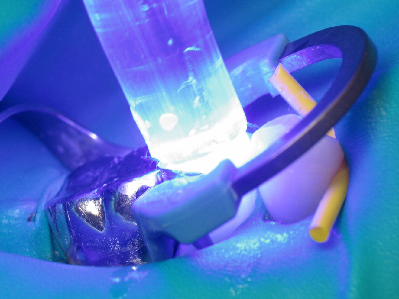 Fig. 11: Light polymerisation of GrandioSO Light Flow.