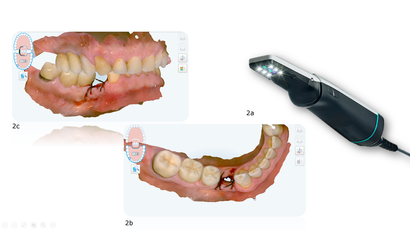 Fig. 2a–c: The intra-oral scanning with iTero Lumina scanner (a) begins with the antagonist quadrant (b) and then with the master model (c) after removal of the healing abutment, followed by the occlusal registration. In this case, the scan was captured immediately after implant placement, while the sutures were still in position.