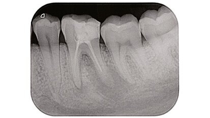 Un’innovativa sistematica per il ritrattamento ortogrado dei canali radicolari: Endo Re-Start (Komet)
