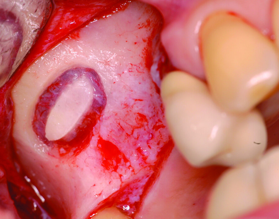 Fig. 5_Antrostomia ultimata.
