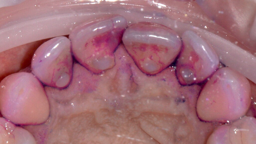 Applicazione del protocollo GBT nel trattamento di un caso di gengivite