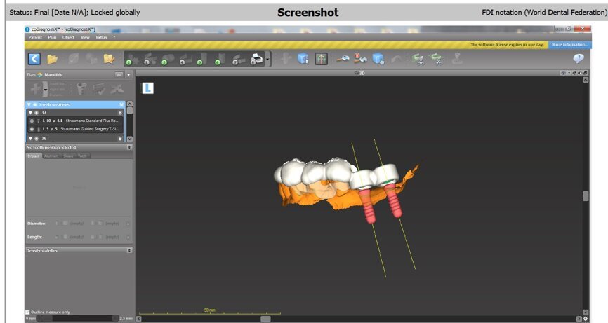 Fig. 6: CodiagnostiX surgical guide.