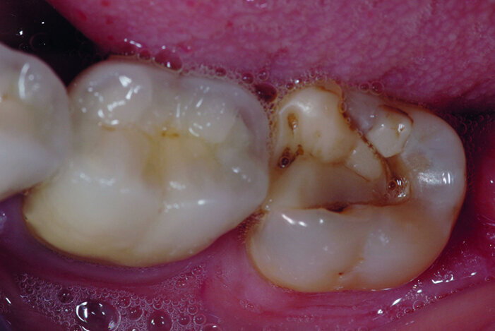 Fig. 2 : Situation initiale. 37
presente une volumineuse restauration
composite non étanche. 
