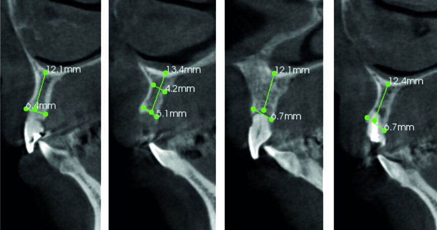 Fig. 4: Pre-op CT analysis.