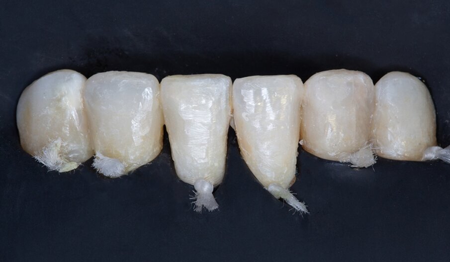 Fig. 5: Final restorations produced with CLEARFIL MAJESTY ES-2 Universal (Universal Dark shade) before finishing and polishing.