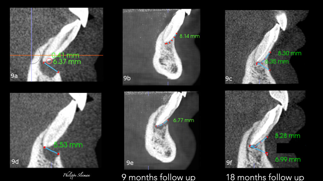Figs. 9a–f: Comparison of the vertical views of the i-CAT scans taken pre-op (a & b) and at the nine-month follow-up (c & d) and 18-month follow-up (e & f), showing continued growth of the bone vertically.