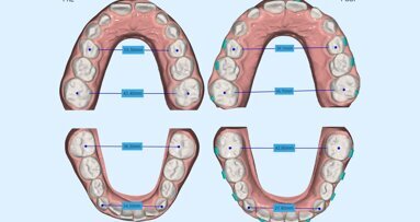 Il trattamento con allineatori in età preadolescenziale: la sfida di Nuvola Genius