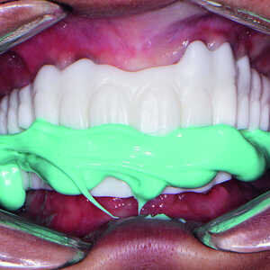 Fig-20-Composant-du-sourire-en-PMMA-300x300-