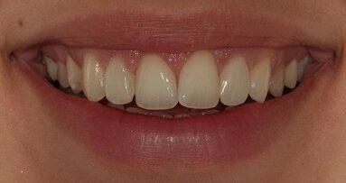 Conservative smile enhancement: Direct composite resin restoration of conoid lateral incisors