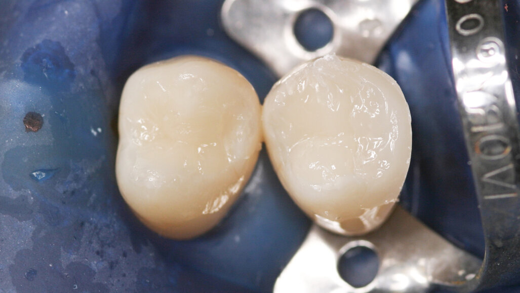 SDR® Plus – The Ideal Bulk-Fill Material in High-C Factor Cavities