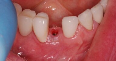 Komplikacje implantoprotetycznej rekonstrukcji braków zębowych – opis przypadku