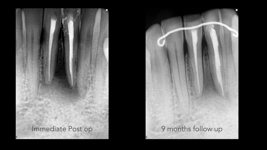 Slike 4a i b: Rendgenski snimci koji pokazuju neposrednu postoperativnu situaciju (a) i situaciju nakon devetomesečnog praćenja (b)