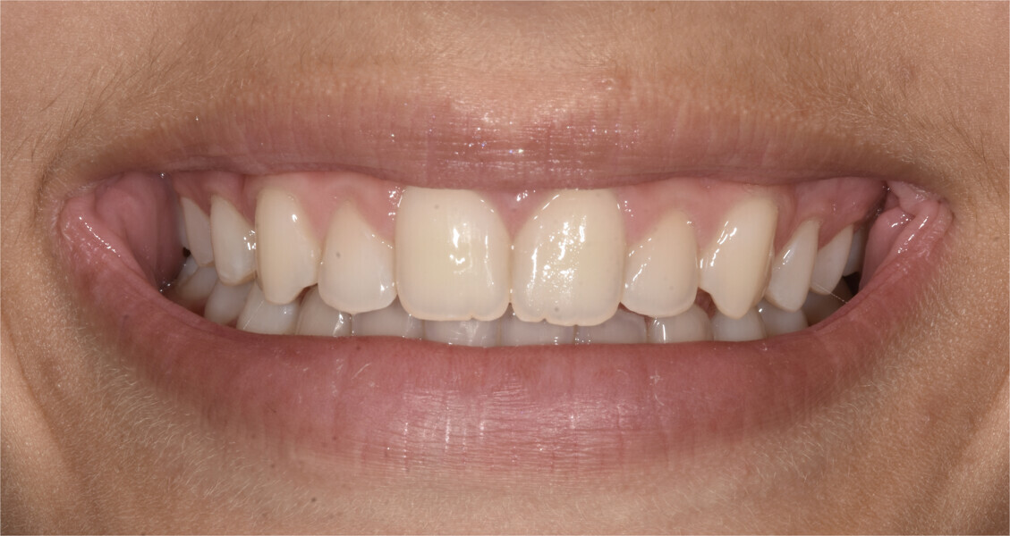 Fig. 10: Facial and intra-oral photographs after treatment with fixed orthodontic appliances.